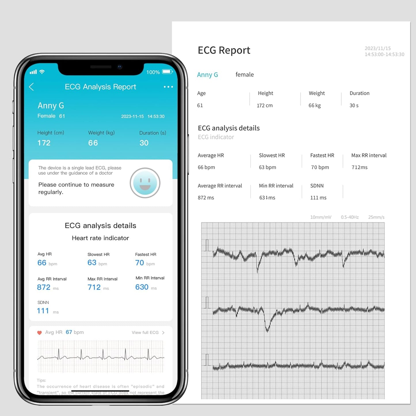 CHOICEMMED Portable ECG Monitor - Record ECG and Heart Rate On-The-Go - Support Storing Up to 200 Records - No Subscription Required